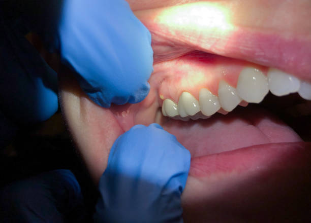 Best Emergency Denture Repair in Blue Ridge, AL